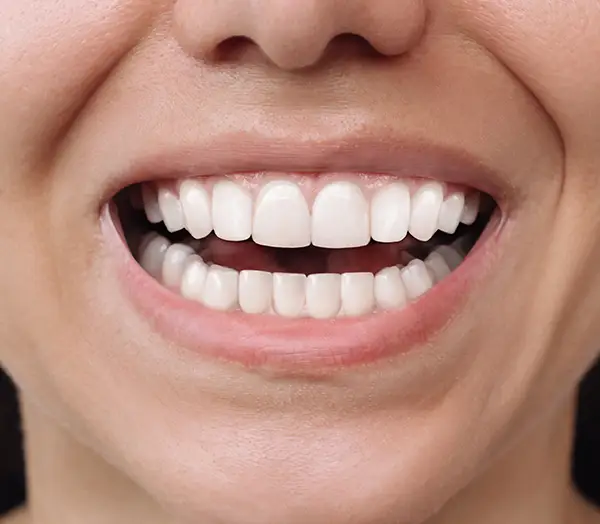 After Invisalign Treatment