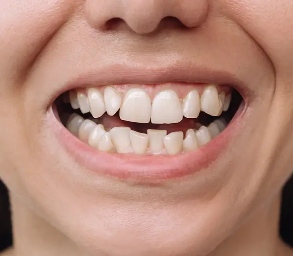 Before Invisalign Treatment