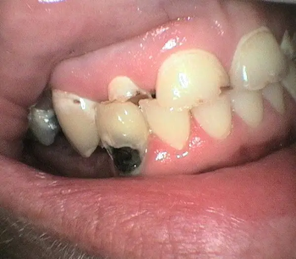 After Crowns