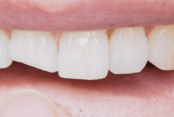 man pointing at chipped tooth in mouth