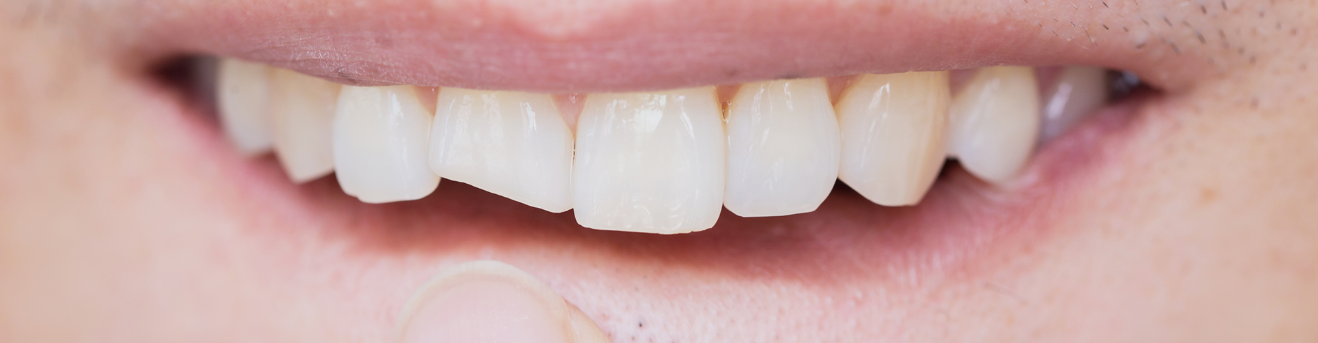 When Your Tooth Cracks: What It Means and What to Do About It
