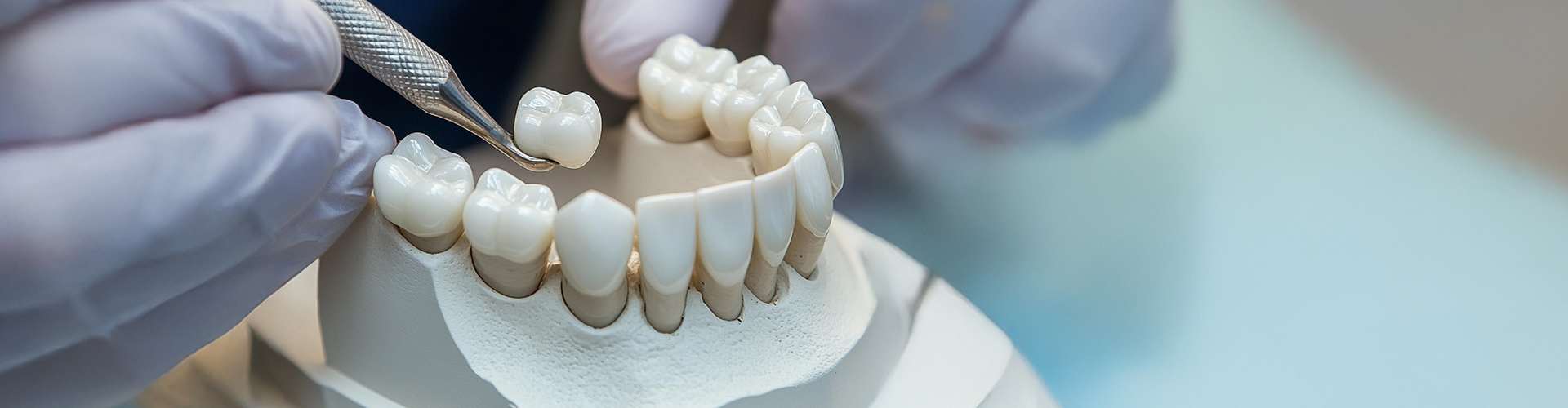 More Than Just a Cap: How Dental Crowns Transform Smiles