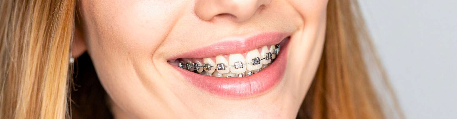 Never Too Old to Start Braces: Why a Straighter Smile Can Happen at Any Age
