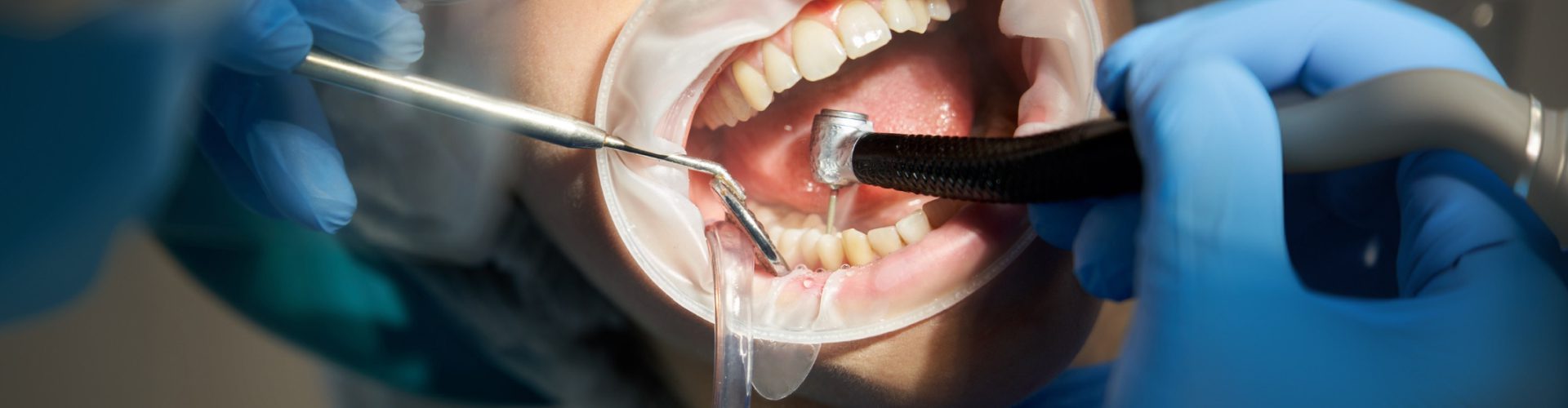 Pulp Capping vs. Root Canal: What Bakersfield Patients Should Know First