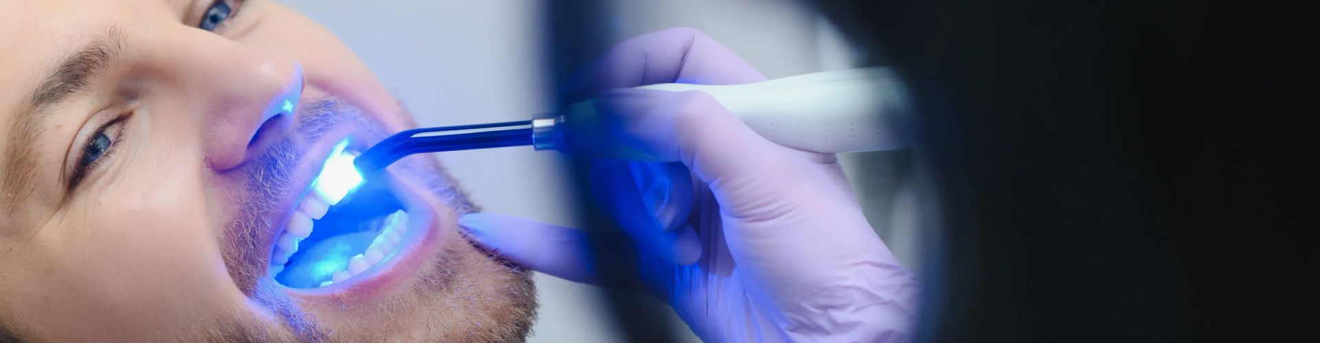 Is Professional Teeth Whitening Safe? What Laurelglen Patients Need to Know