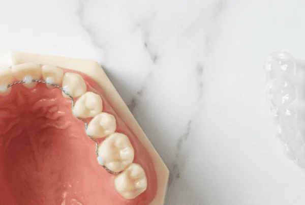 Jaw model with lingual braces beside a clear retainer in a blue case.
